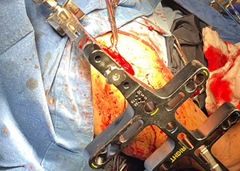 humeral-nail-insertion-procedure-czmeditech2 procedimiento-de-inserción-de-uña-humeral-czmeditech2