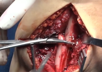 clavicle-surgery-orif-procedure-mexico-czmeditech cirugia-de-clavicula-procedimiento-orif-mexico-czmeditech