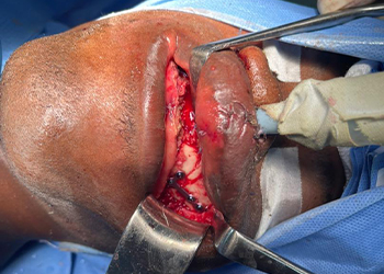 intraoperative-view-maxillofacial-plate-fixation-ghana3-czmeditech vista-intraoperatoria-fijación-con-placa-maxilofacial-ghana3-czmeditech