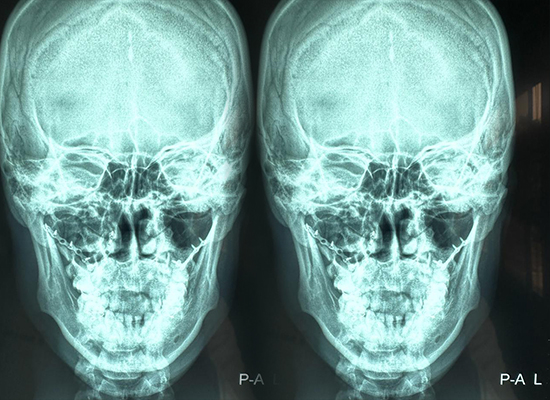 postoperative-outcome-maxillofacial-fixation-humeral-head resultado-postoperatorio-fijación-maxilofacial-cabeza-humeral