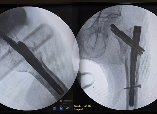 Postoperative X-ray after Intertan Intramedullary Nail fixation of left intertrochanteric fracture-czmeditech Radiografía posoperatoria tras la fijación con clavo intramedular Intertan de una fractura intertrocantérea izquierda-czmeditech