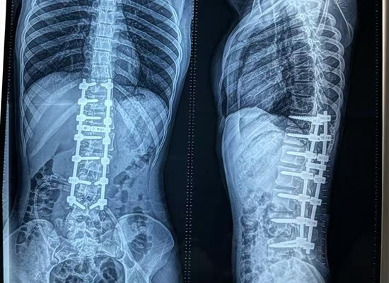 Postoperative X-ray showing corrected spinal alignment after scoliosis surgery in Bangladesh-czmeditech Radiografía posoperatoria que muestra la alineación espinal corregida después de una cirugía de escoliosis en Bangladesh-czmeditech