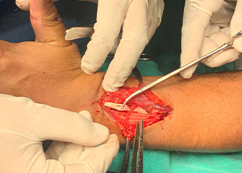 intraoperative-tendon-exposure-tenorrhaphy-peru-czmeditech exposición-tendón-intraoperatoria-tenorrafia-perú-czmeditech