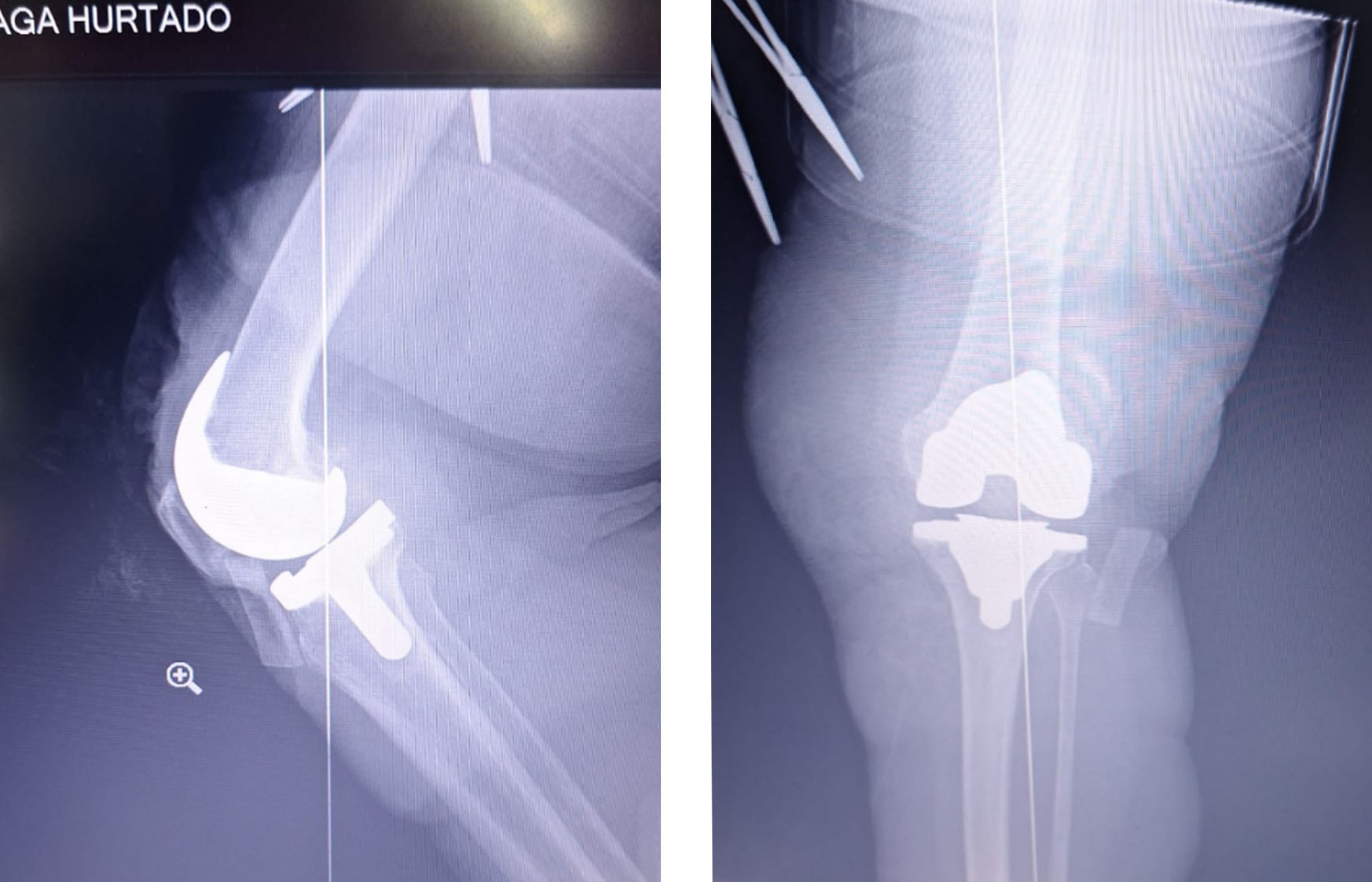 tkr-postoperatorio-rayos-x-prótesis-de-rodilla