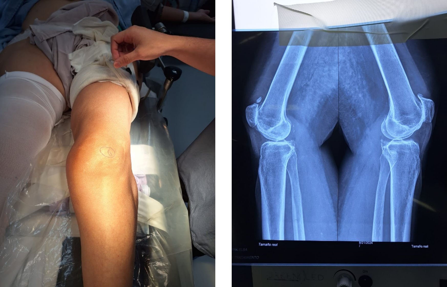 deformidad-hinchazón-de-rodilla-preoperatoria