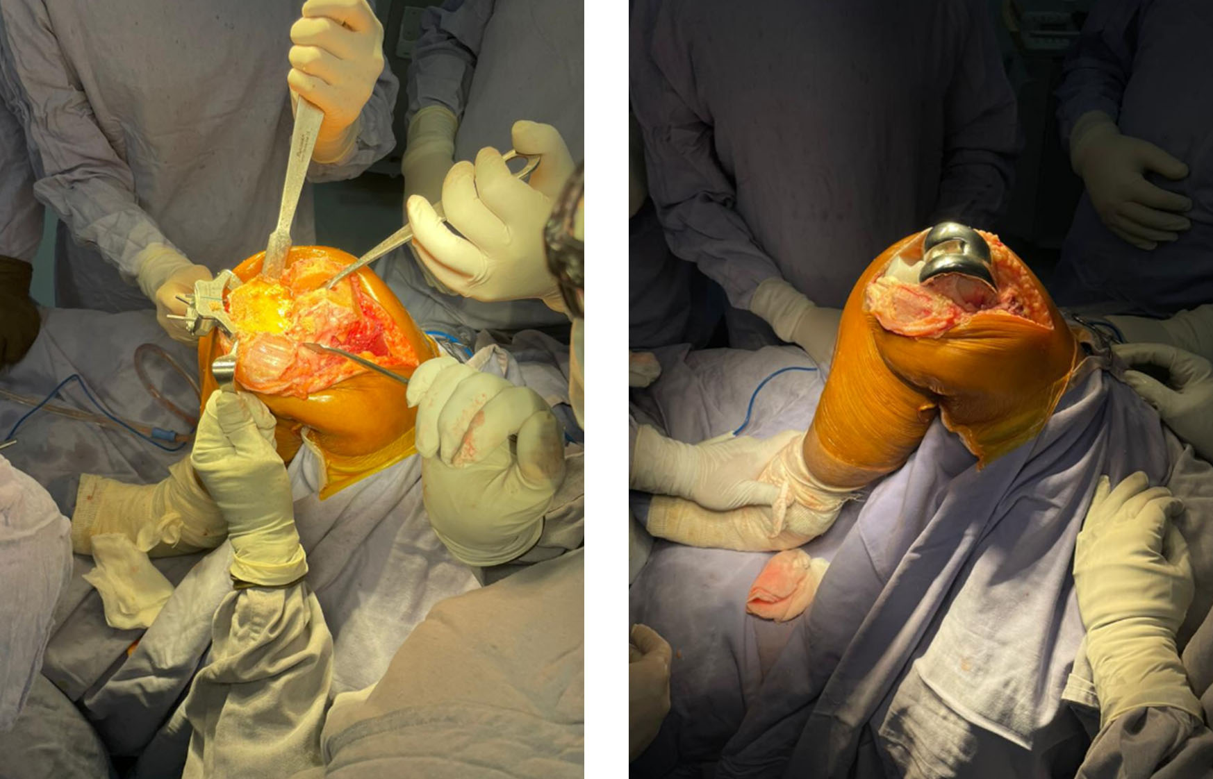 intraoperatorio-tkr-cirugía-implante.