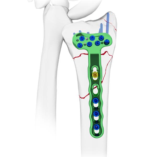 Placa de bloqueo radial volar distal: tratamiento avanzado de fractura de muñeca