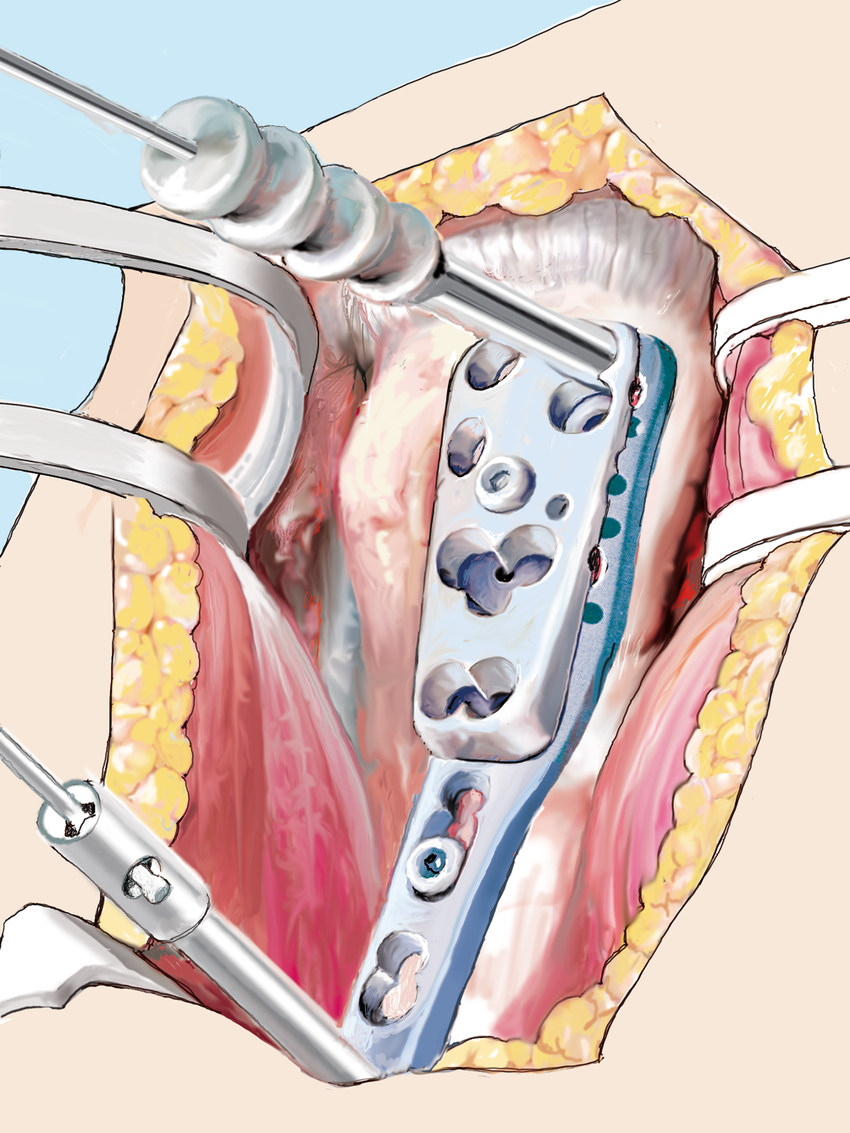 Placa de bloqueo humeral proximal