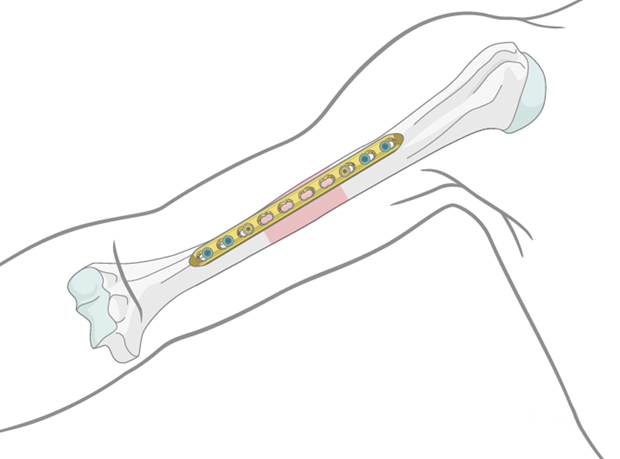 Placa de bloqueo para diáfisis humeral: un enfoque moderno para el tratamiento de fracturas