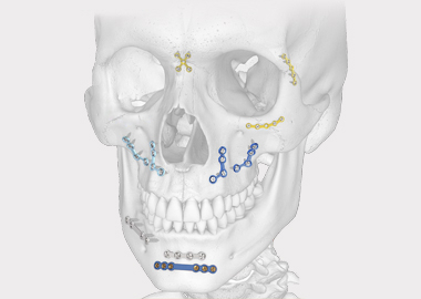Sistema de recubrimiento maxilofacial