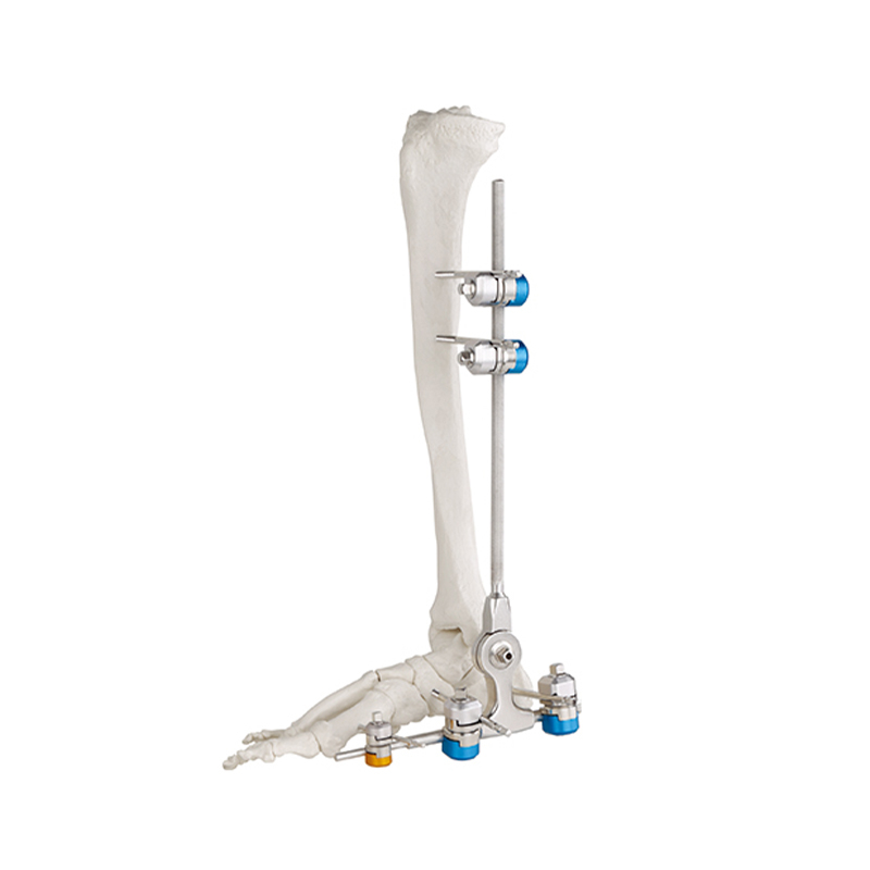 Junta de fusión de tobillo fijador externo