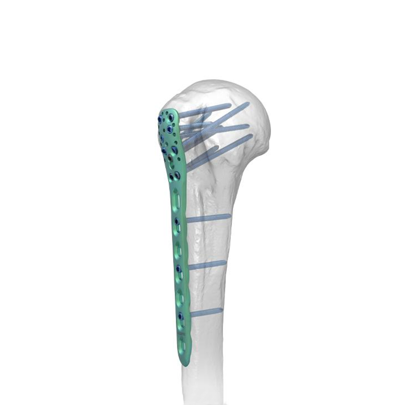 Placa de bloqueo humeral proximal