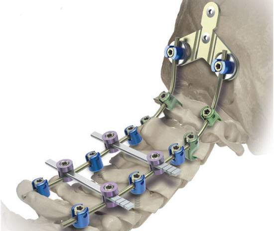 Tornillo pedicular de fijación de vértebras cervicales posteriores_副本_副本