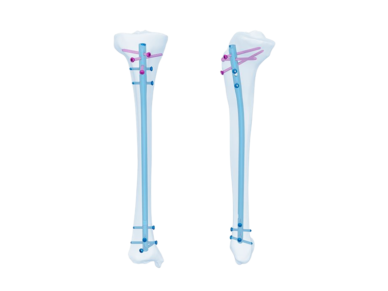 Clavo intramedular tibial experto: mejora de las cirugías ortopédicas