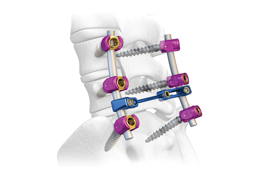 Qué-es-los-implantes-de-columna