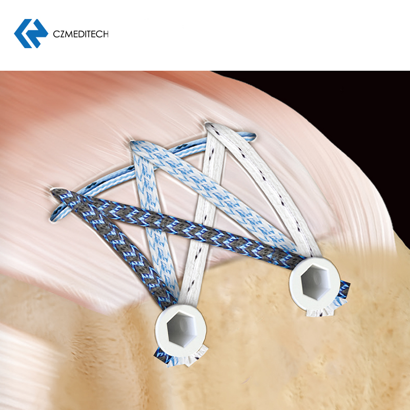 Sutura de polietileno Sutura Ethicon 