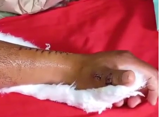 recuperación-postoperatoria-movimiento-del-pulgar-medicina-deportiva-czmeditech 