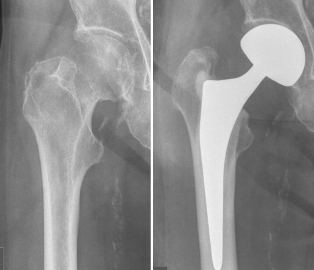 Los 5 problemas más candentes de la fractura del cuello femoral, ¡sus compañeros están lidiando con esto!