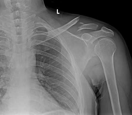 fractura de clavícula
