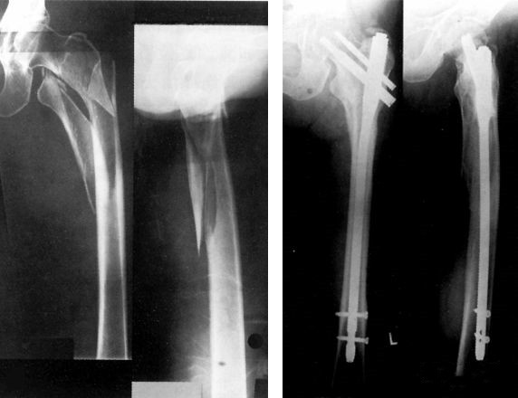 Fractura femoral proximal-fractura intertrocantérea