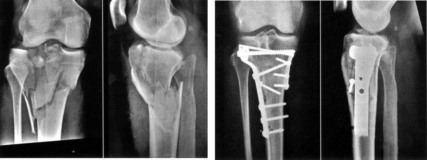 Fractura tibial proximal