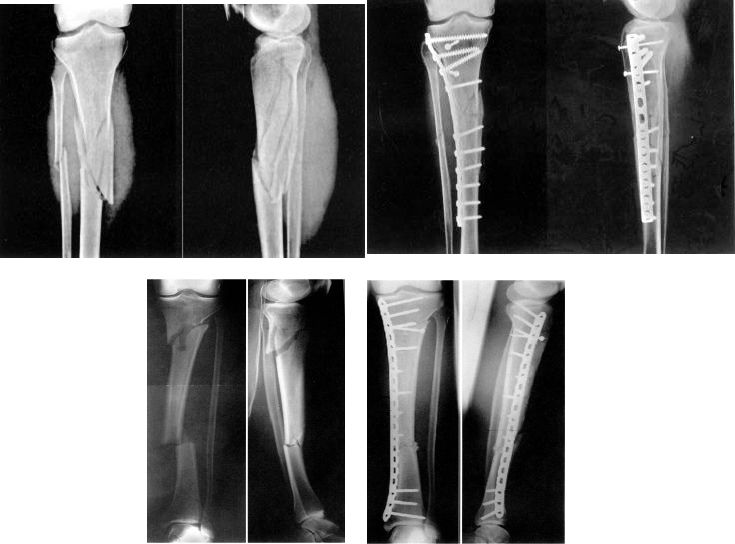 Fractura del eje tibial