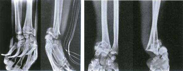 Fractura de radio distal