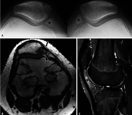 tratamiento inestabilidad de la articulación femororrotuliana en niños