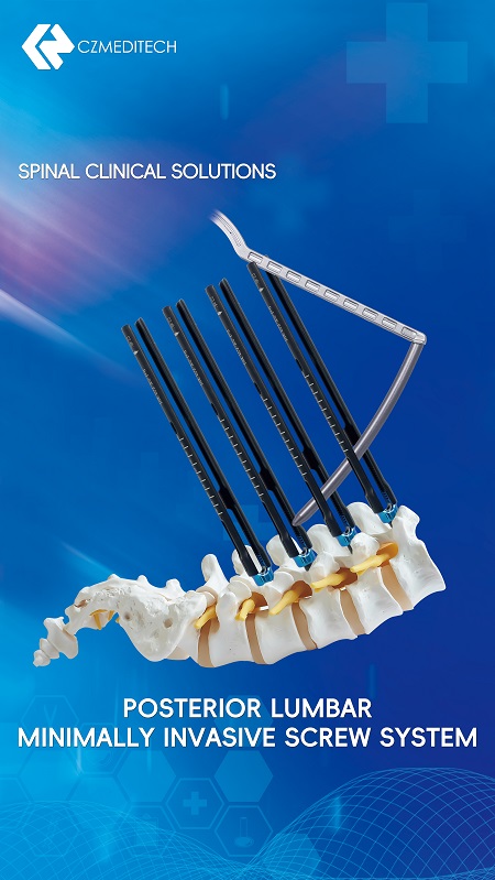 Sistema de tornillo mínimamente invasivo posterior lumbar 