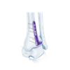 VA Distal Tibia Bloqueado L-placa