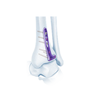 VA Distal Tibia Bloqueado L-placa