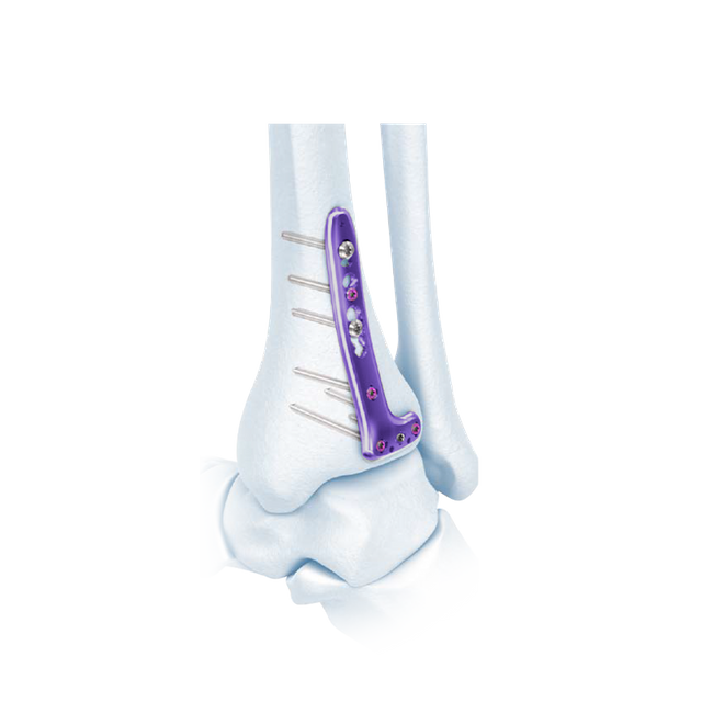 VA Distal Tibia Bloqueado L-placa