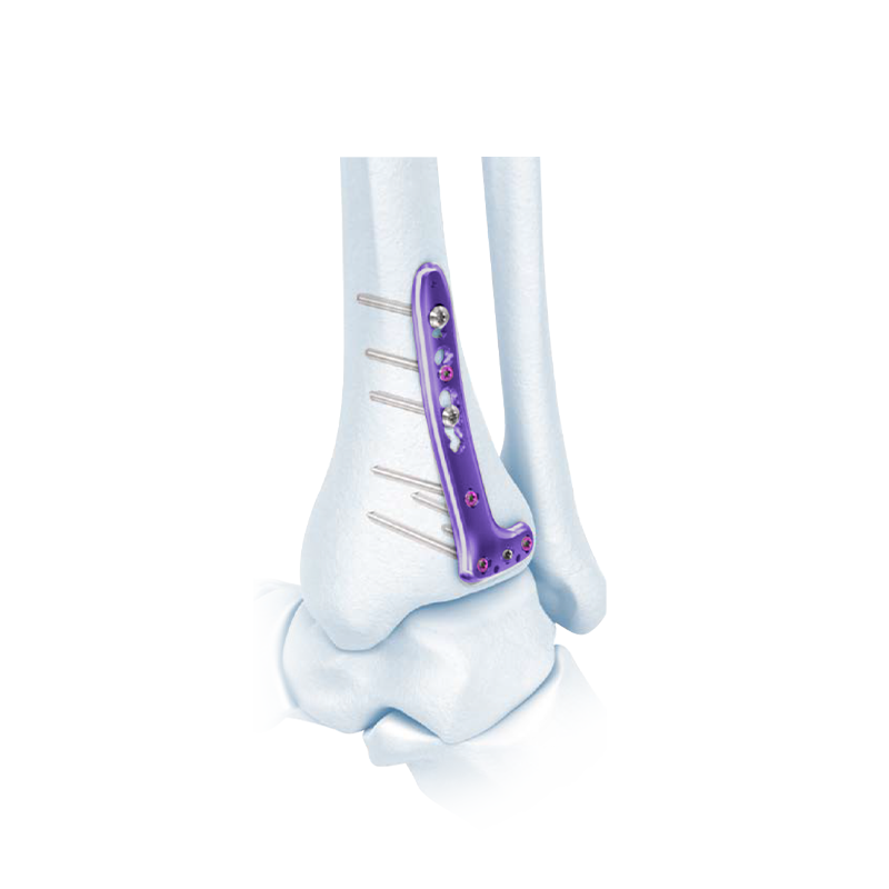 VA Distal Tibia Bloqueado L-placa