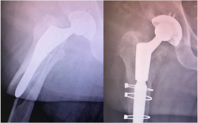Fijación con alambre de artroplastia y cerclaje para fracturas de colgajo retrógrado.