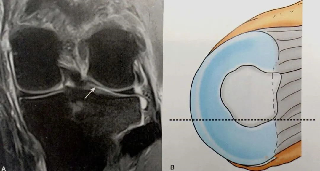 resonancia magnética coronal
