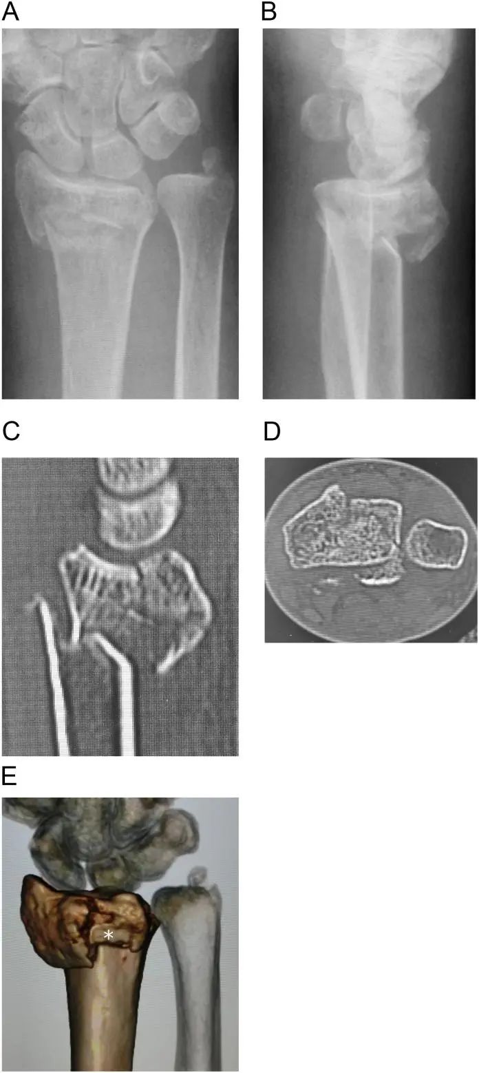 fractura de radio distal