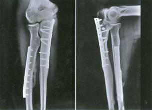 Fractura de antebrazo doble
