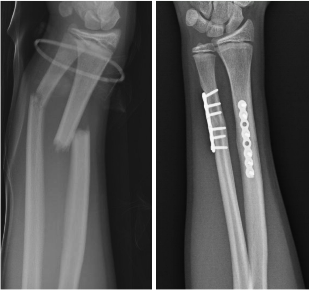 ¿Cuándo necesita una cirugía de fractura?