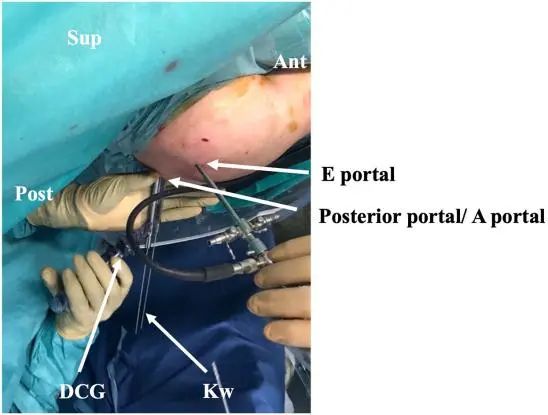 Tratamiento artroscópico de la inestabilidad posterior del hombro