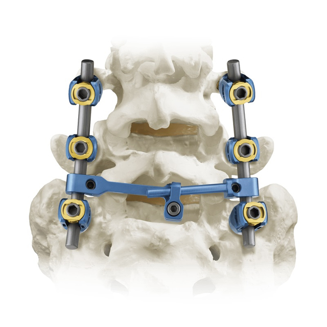 5.5 Sistema de tornillo pedicular espinal
