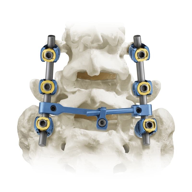 5.5 Sistema de tornillo pedicular espinal