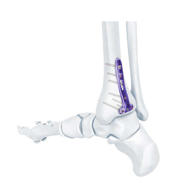 VA Distal Tibia Bloqueado T-placa