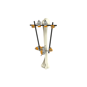 Húmero proximal fijador externo