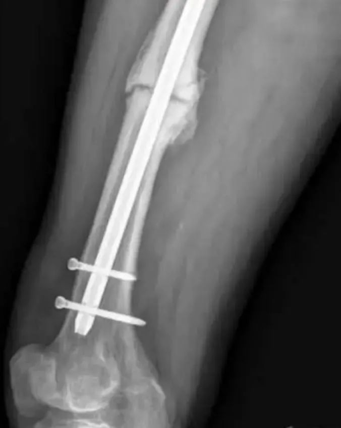 Seudoartrosis de fractura