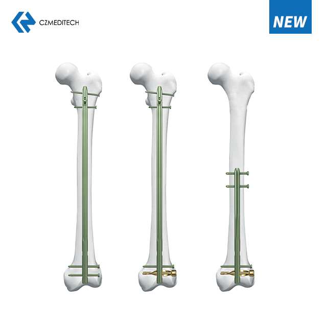 Experto R/Afn.Clavo femoral retrógrado/anterógrado