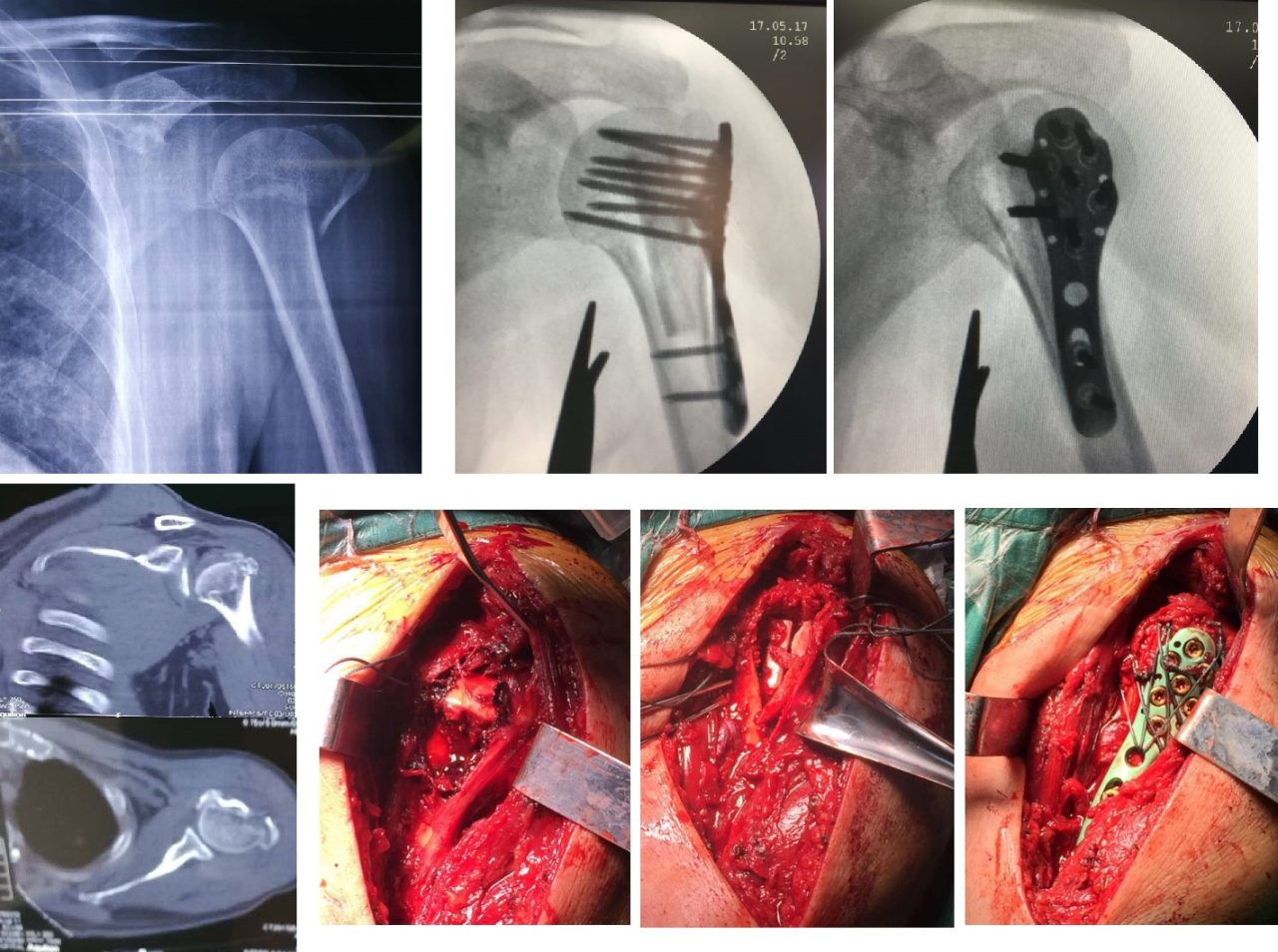 Fractura de húmero proximal