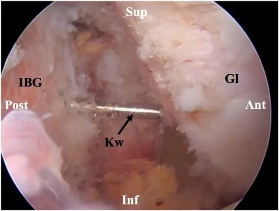 Tratamiento artroscópico de la inestabilidad posterior del hombro