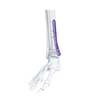 VA Placa de bloqueo de tibia medial distal