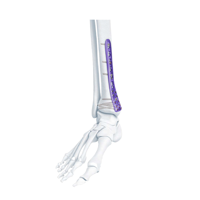 VA Placa de bloqueo de tibia medial distal