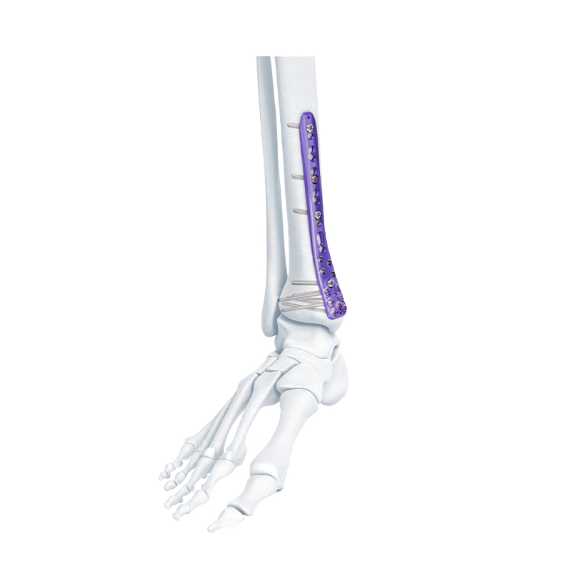 VA Placa de bloqueo de tibia medial distal